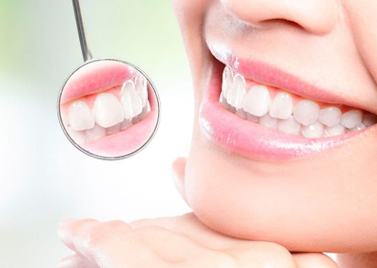 Dientes blancos tras un blanqueamiento dental profesional en Clínica Smiles Cali