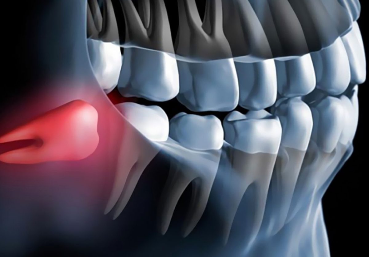 Radiografía de una cordal retenida, caso de cirugía oral en Clínica Smiles Cali