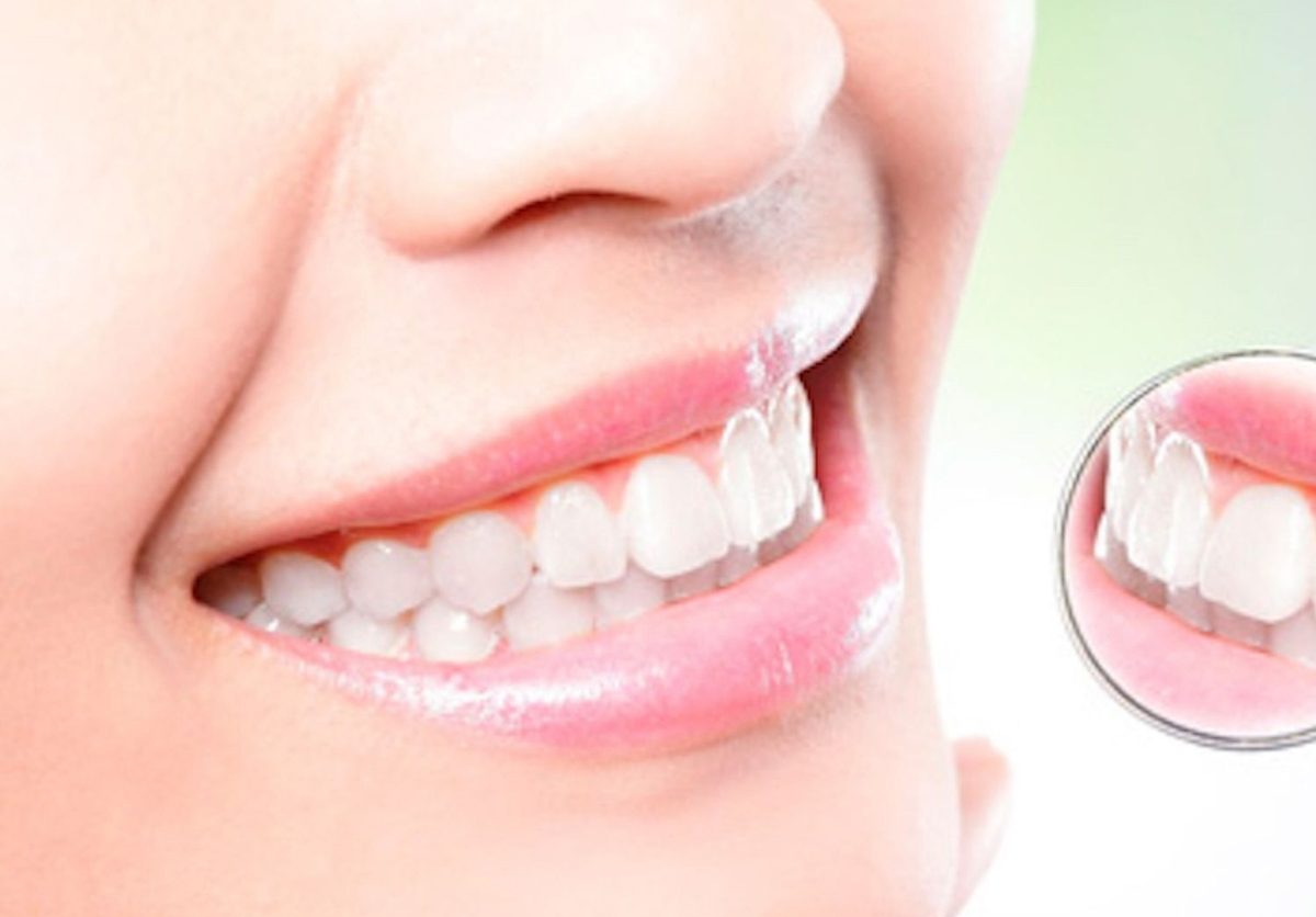Resultado de un diseño de sonrisa en Clínica Odontológica Smiles Cali