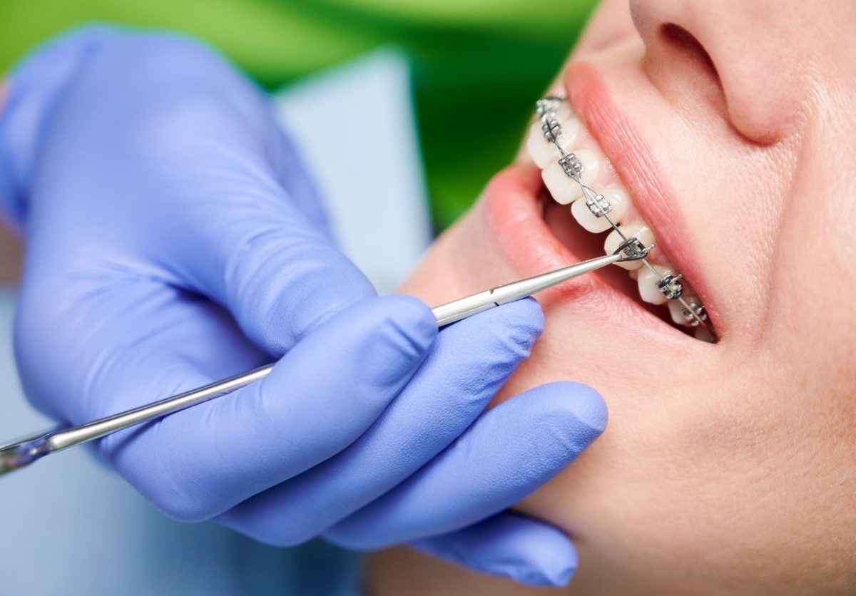 Control de brackets en un tratamiento de ortodoncia en Clínica Smiles Cali